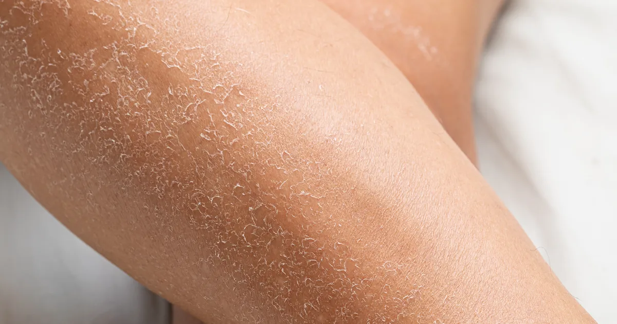 Need asjad võivad muuta naha kuivaks