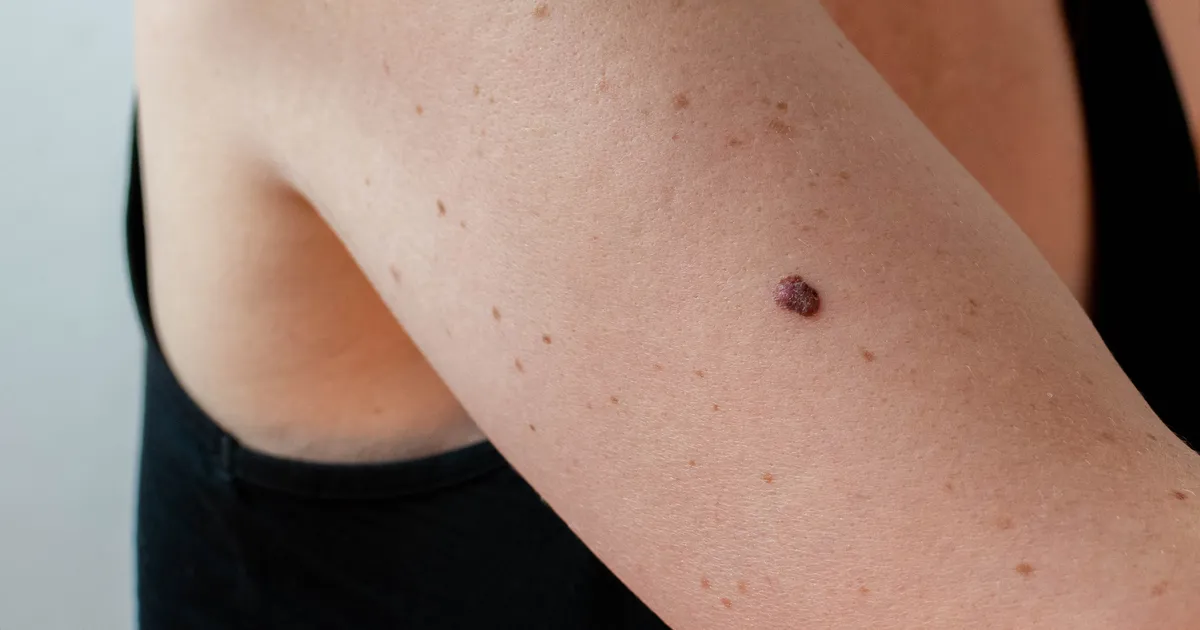 Teadlased avastasid, mis pärsib vähki