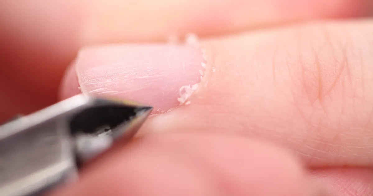 Miks küünenahad katki lähevad ja kuidas neid kiirelt parandada?