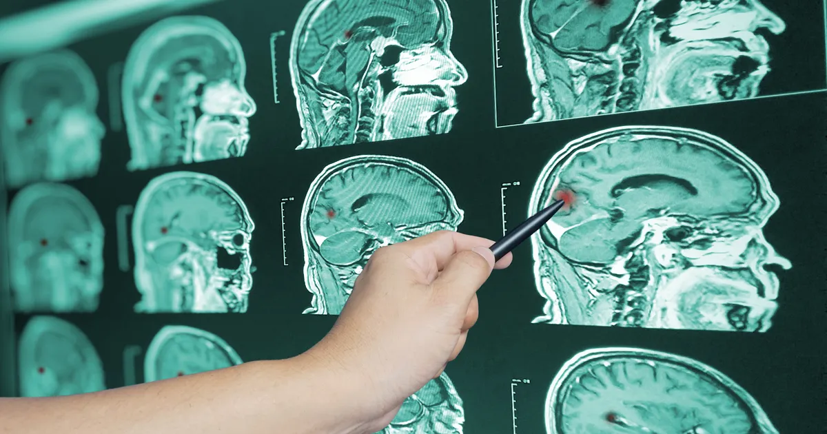 Mida lapsepõlvetrauma ajuga teeb?