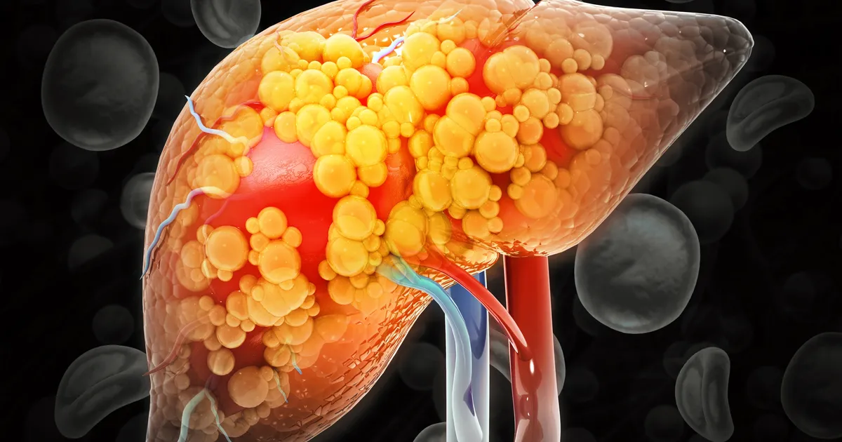5 märki, mis võivad viidata rasvmaksa haigusele