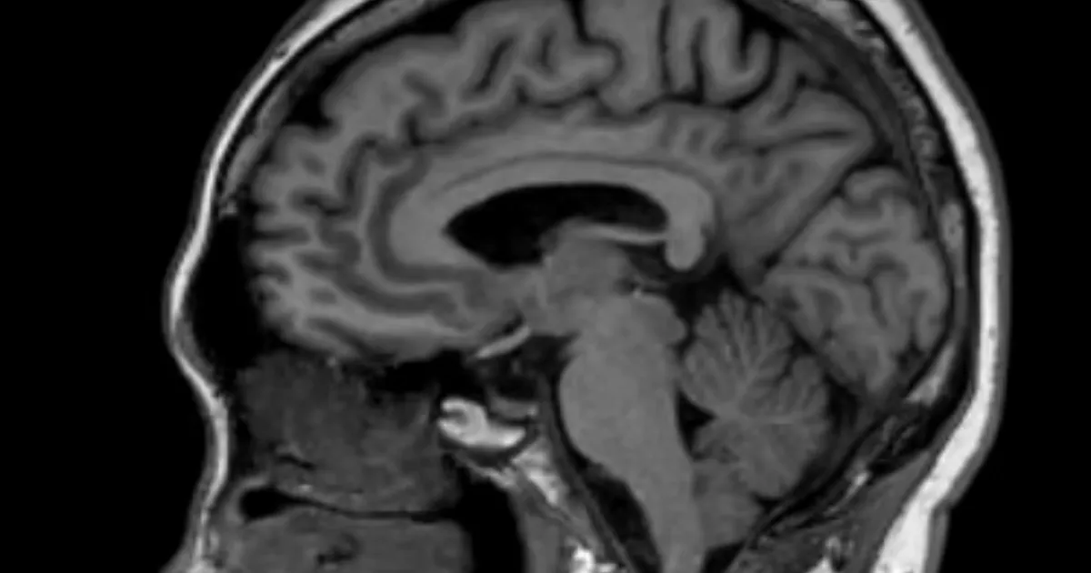 VIDEO ⟩ Ajukude võib sisaldada suuremas koguses mikroplasti kui teised elundid