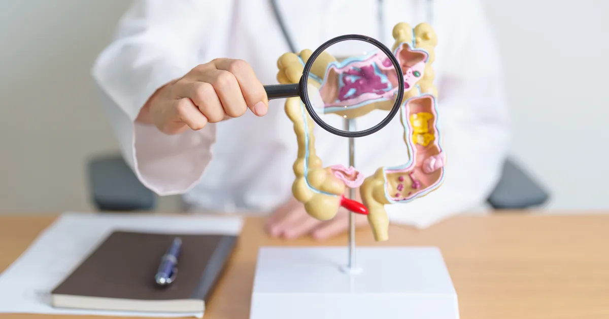 Vaata järele, kas oled oodatud soolevähi sõeluuringule