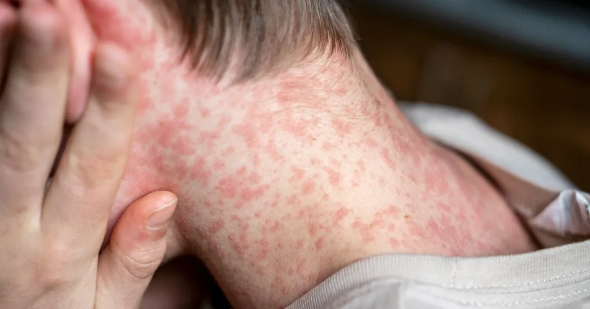 USA terviseagentuur andis seoses leetrite puhanguga reisihoiatuse