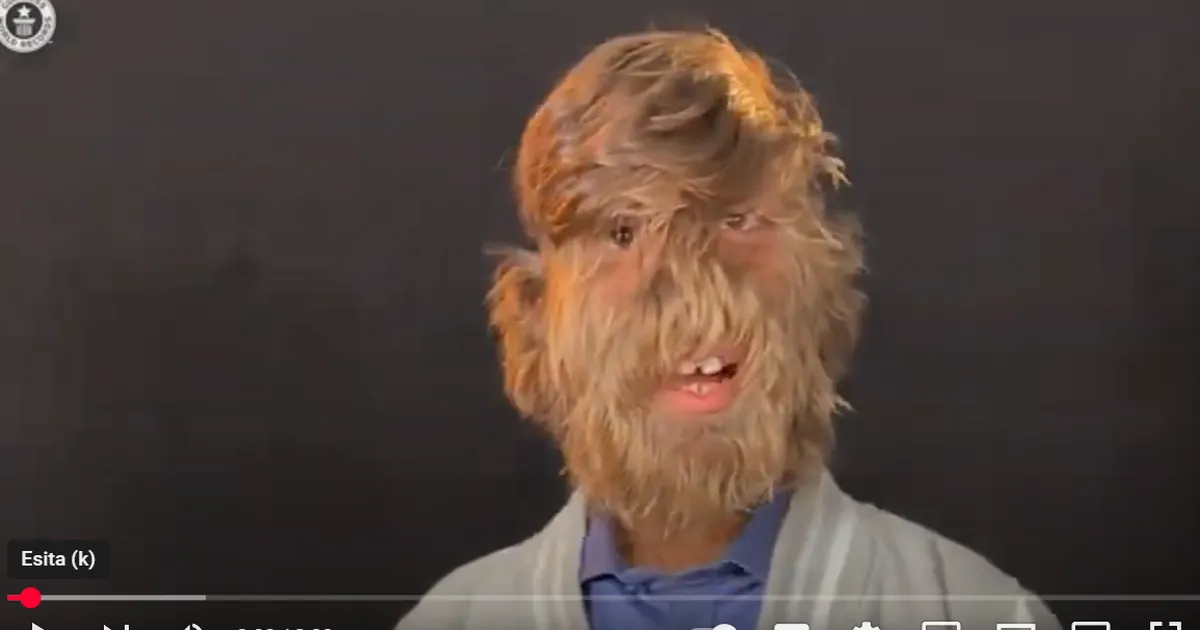 LIBAHUNDI SÜNDROOM ⟩ Maailma karvaseima näoga poiss jõudis Guinnessi rekordite raamatusse