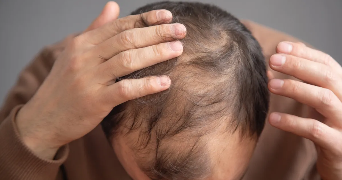 Juuksed või mehelikkus? Noor mees kaotas kiilaspäisuse ravi tõttu suguvõime