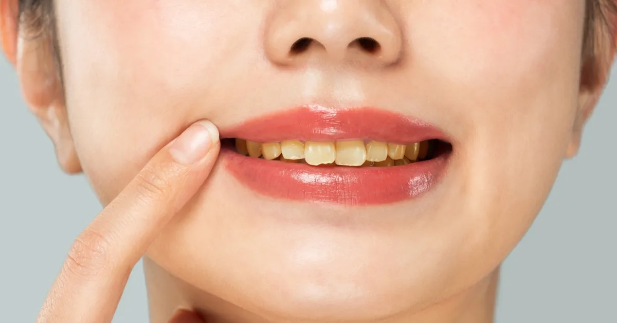 Need levinud hambapesupatud võivad olla kollaste hammaste põhjusteks