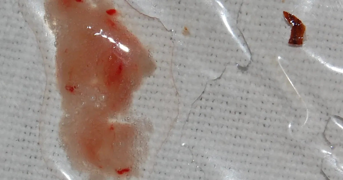 Venemaal levib tundmatu vere köhimist põhjustav viirus?