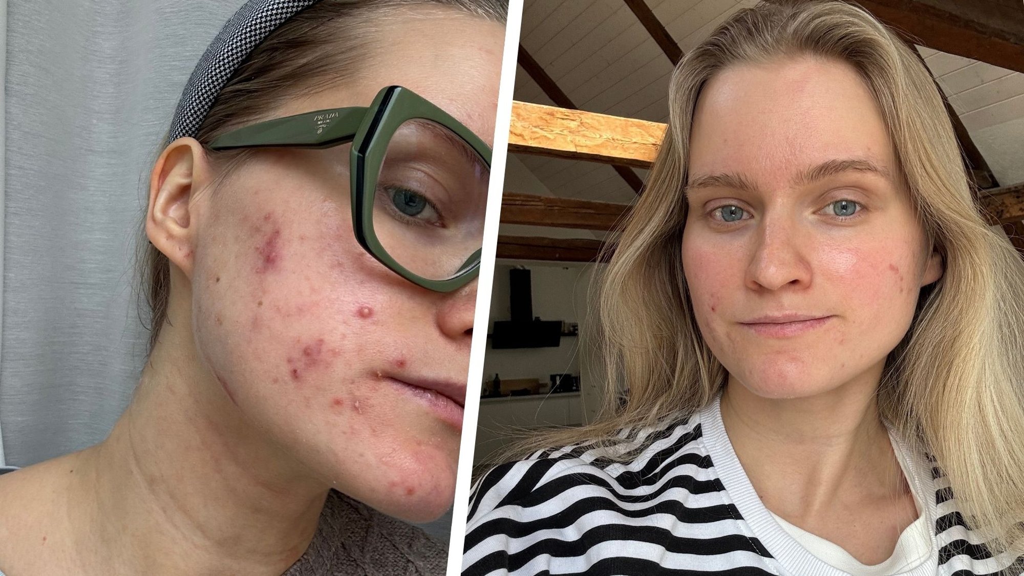 Aknega võitlev Heelia Sillamaa rumalatest nõuannetest: mulle kirjutati, et ära seda ravimit küll võta, sest see on täielik mürk