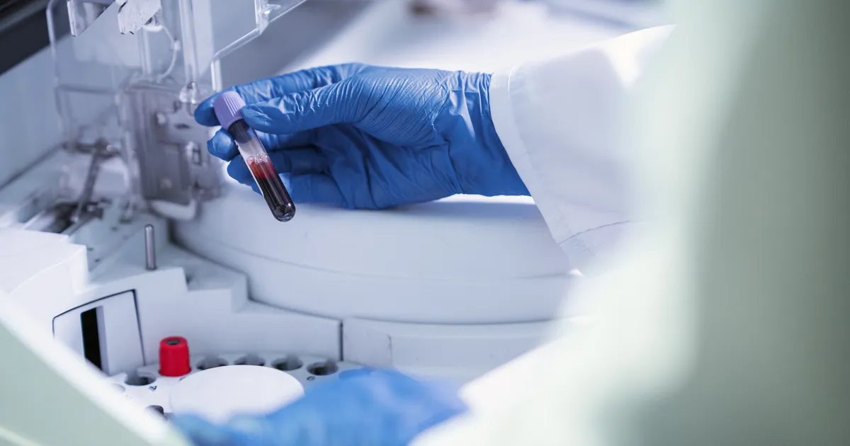 Statistika: nii kõrge on Eesti inimeste kolesteroolitase