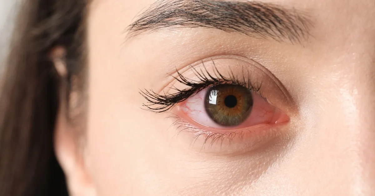 Astu koduste vahenditega punaste silmade vastu!