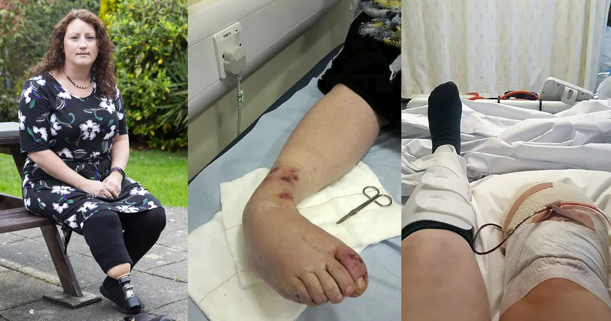 VIDEO ⟩ Kuidas parfüümipudeli ja koera kriimustus viisid naisel kahe jäseme amputeerimiseni