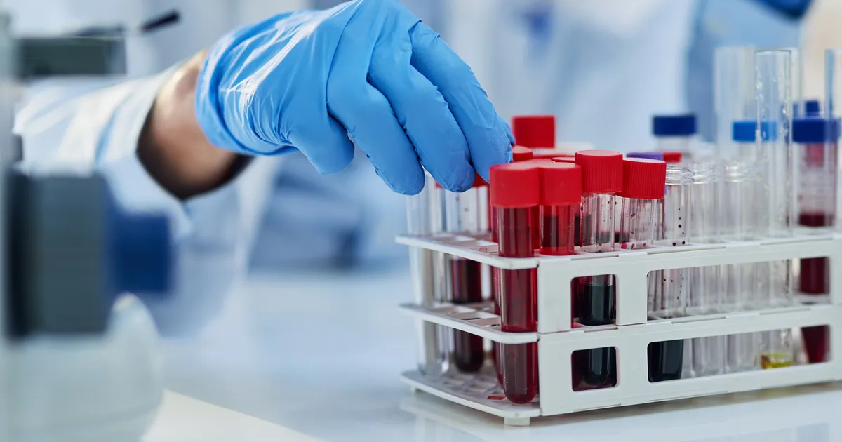 Ajalooline läbimurre: Alzheimeri tõbe on nüüd võimalik tuvastada vereprooviga