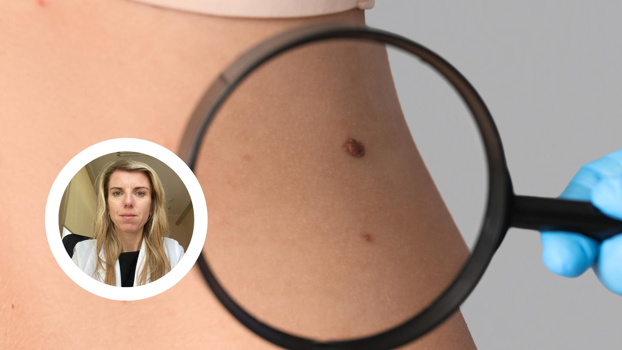 VÕRDLE | Milline näeb välja healoomuline ja pahaloomuline sünnimärk? Soovitused naha kontrollimiseks