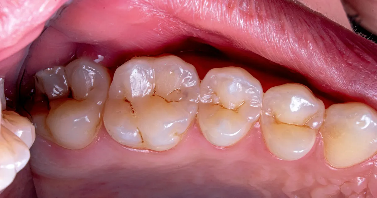 Need kaks ravivõtet võivad peatada laste hambaaukude tekke aastateks