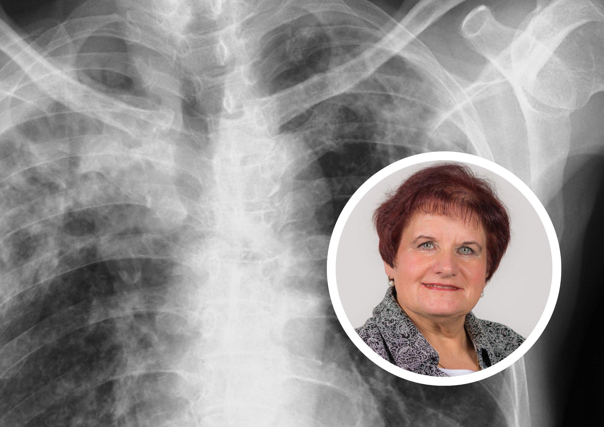 Tuberkuloosi sümptomid võivad avalduda aastaid peale nakatumist. Arst selgitab, kuidas haigestumist ära tunda