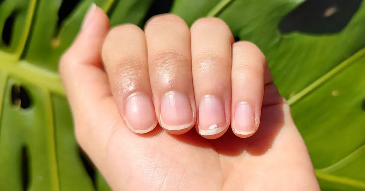 Mida tähendavad valged laigud küüntel – ja millal muretseda?