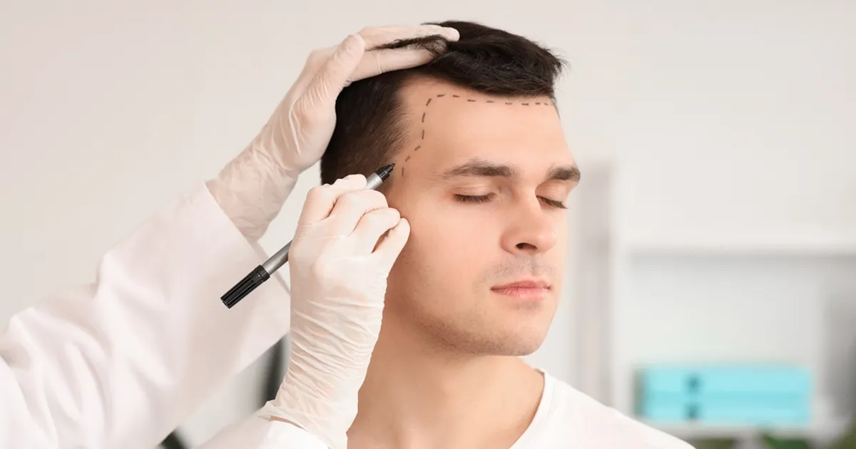 Miks ei tohi pärast juuste siirdamist seksida? Selle mehe nägu annab vastuse