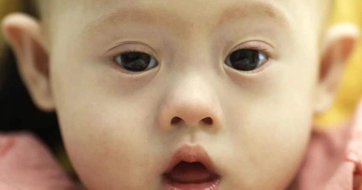 Läbimurre Downi sündroomis: teadus kustutas liigse kromosoomi