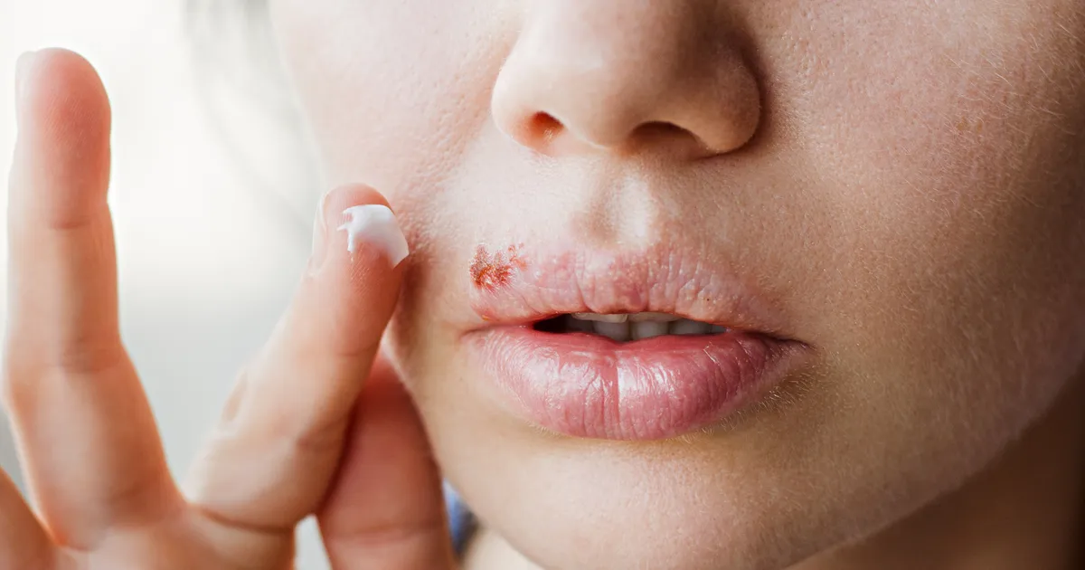 Miks lapseeas saadud herpesviirus meid täiskasvanuna haigeks teeb?