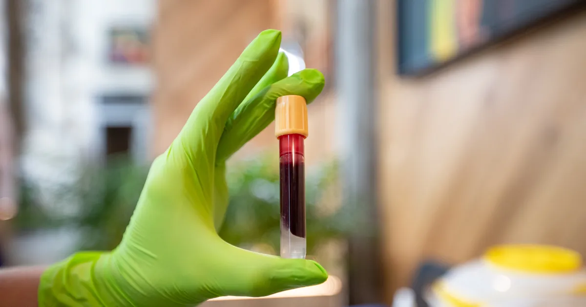 Uus vereanalüüs võib Alzheimeri diagnoosimist pöördeliselt muuta