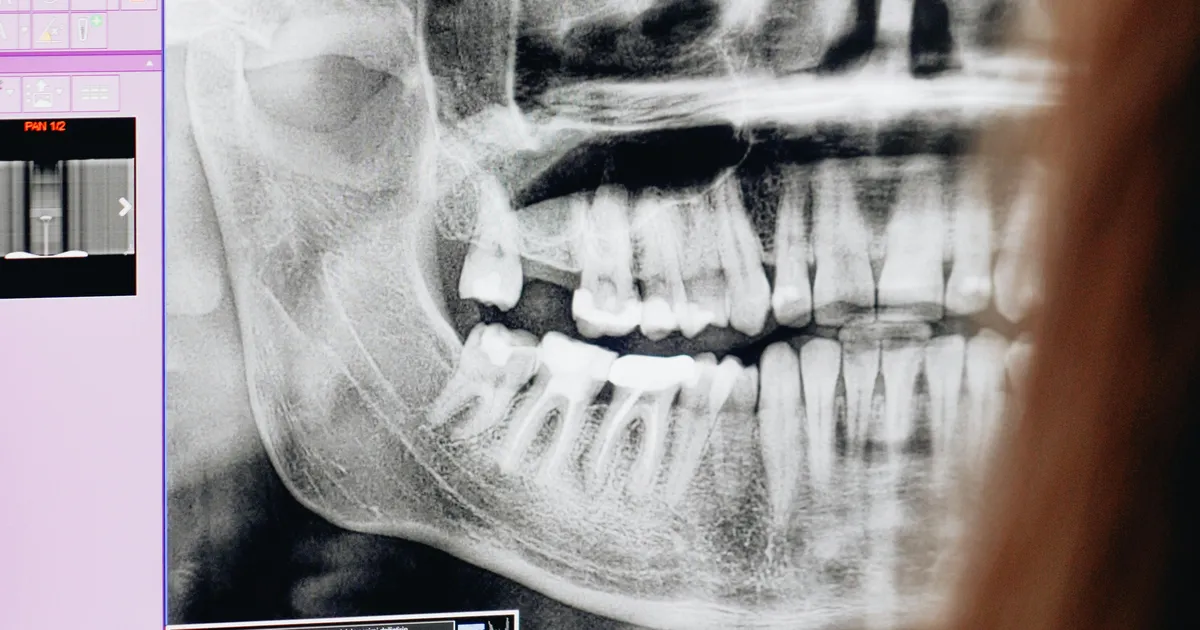 Kuidas on lood inimesele uusi hambaid kasvatava ravimiga? 5 aasta pärast on see valmis