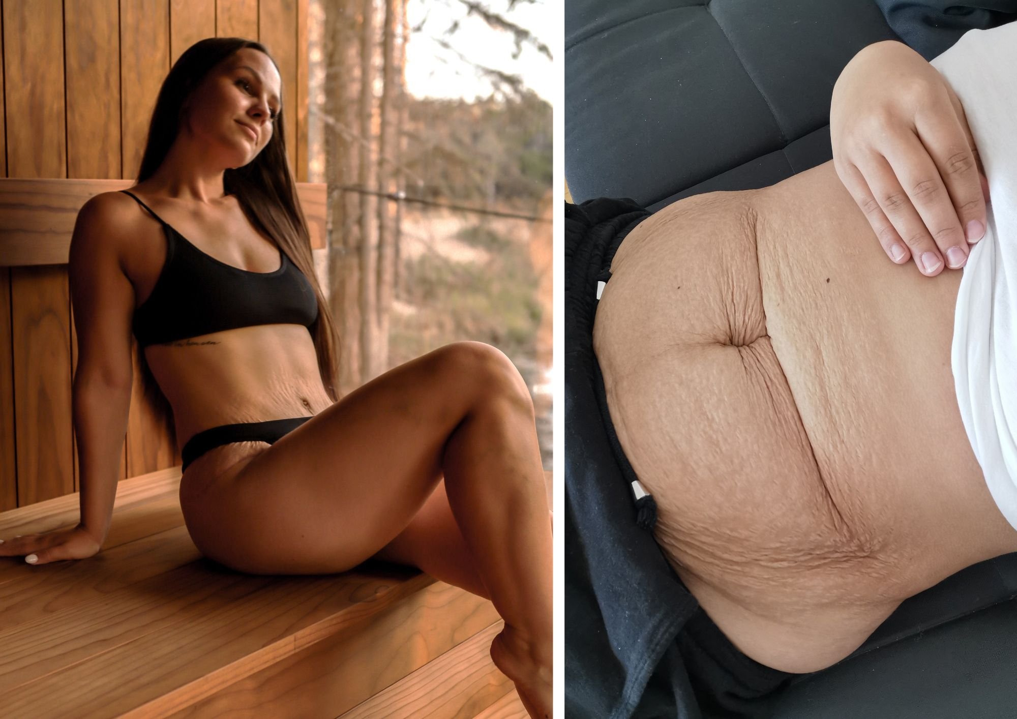 „Elu rippuva kõhuga polnud enam võimalik.“ Sigridil ja Marjel eemaldati kõhuplastikaga üle kolme kilo liigset nahka ja rasva