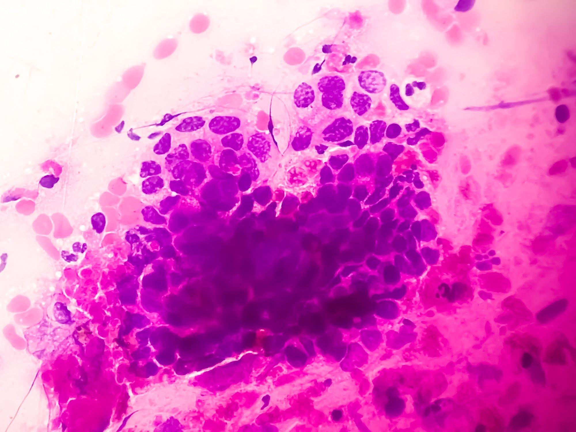 Müüdid ja tõed HPV kohta, mida iga naine peaks teadma ennetusest. Kas täiskasvanud naine peaks end vaktsineerima?