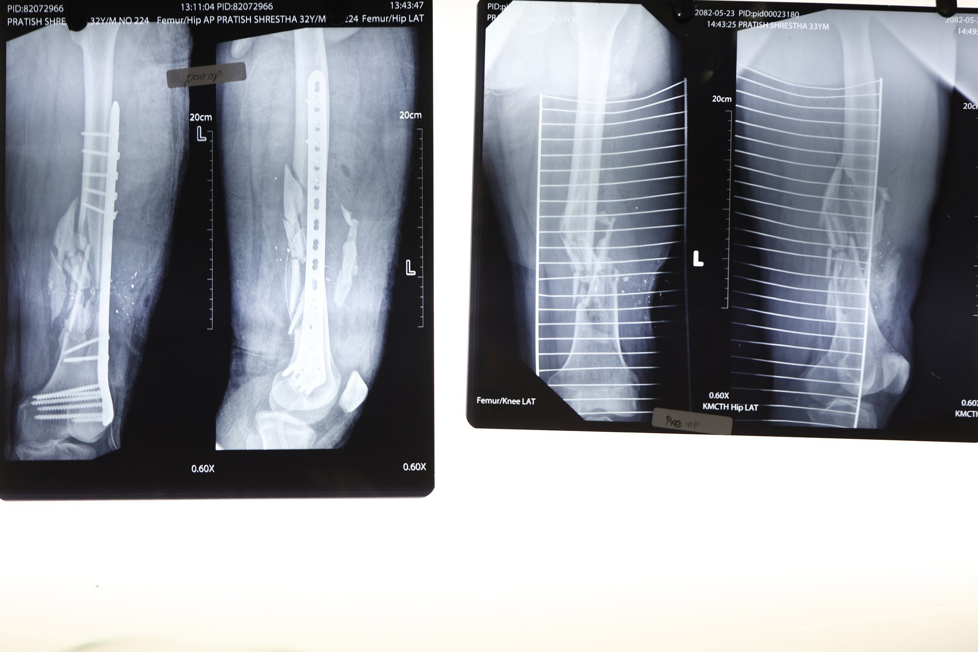 Hiinlased lõid „superliimi“ luude jaoks. See parandab murrud vaid loetud minutitega