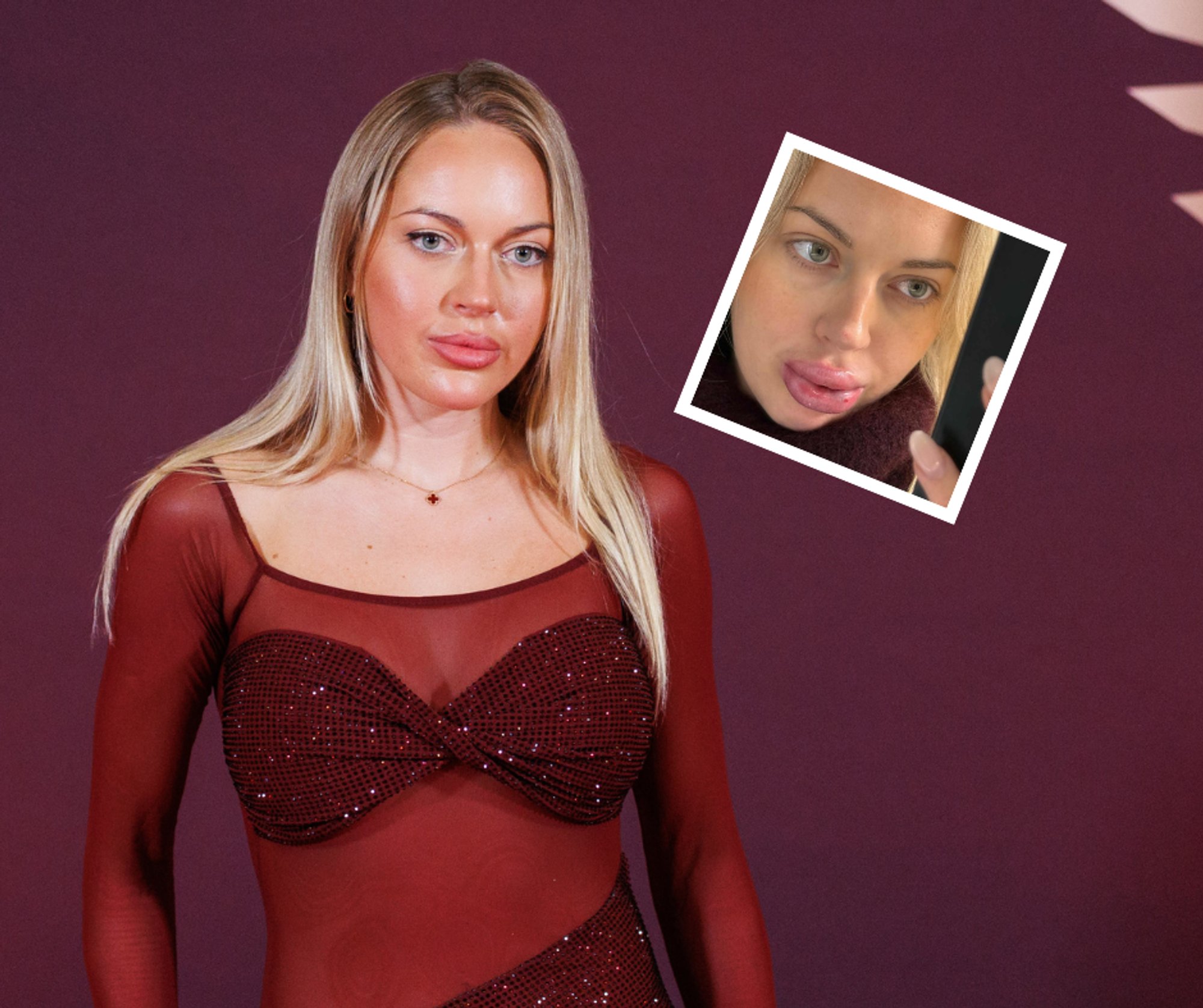 VIDEO | „Ma ei taha neid enam täita.“ Sisulooja Erna Husko huuled läksid pärast täiteaine eemaldamist korralikult paiste