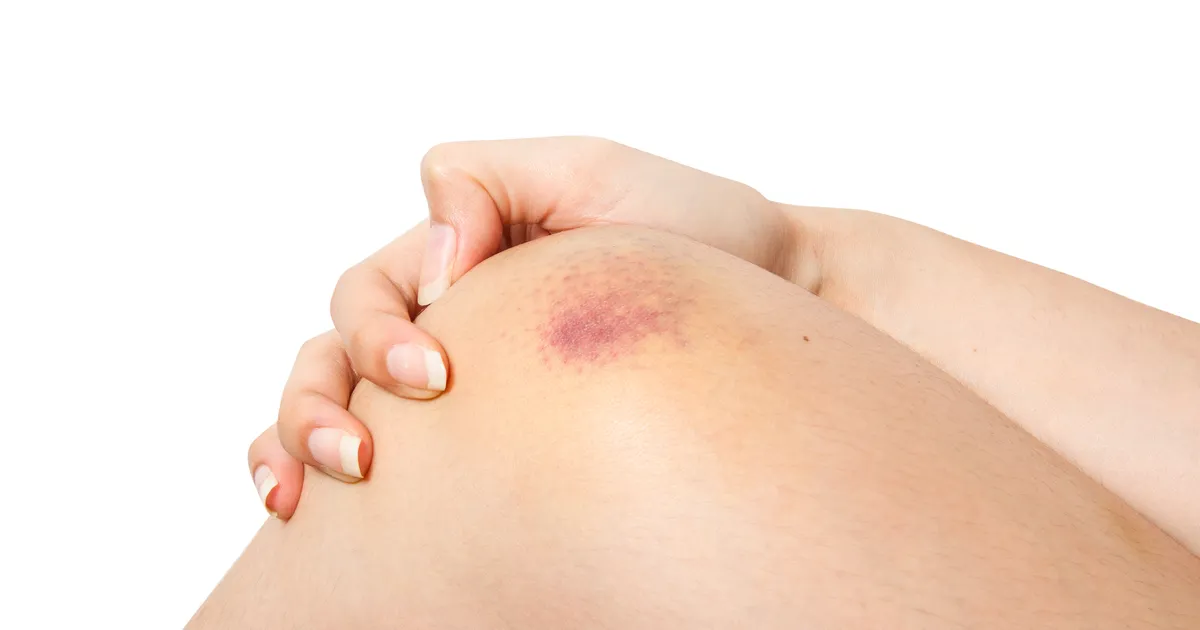 VIDEO ⟩ Kuidas 37-aastase naise sinikas viis ajaloolise haiguse diagnoosini