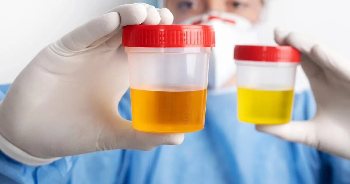9 hoiatavat märki uriinis, mida ei tohiks eirata
