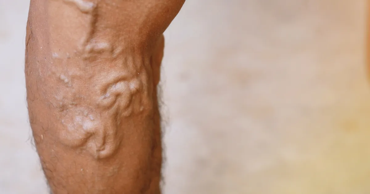 TASUB TEADA ⟩ 8 viisi, kuidas veenilaiendeid ennetada