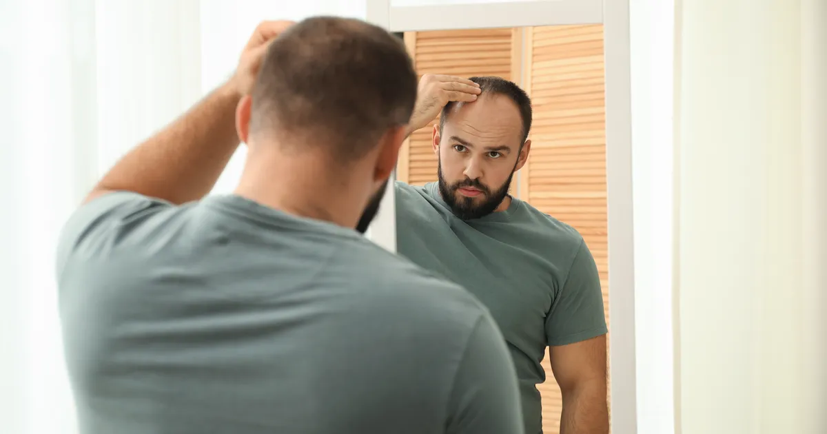 LÄBIMURRE!? ⟩ Pikaajaline kiilaspea võib tulevikus 20 päevaga juuksed tagasi saada