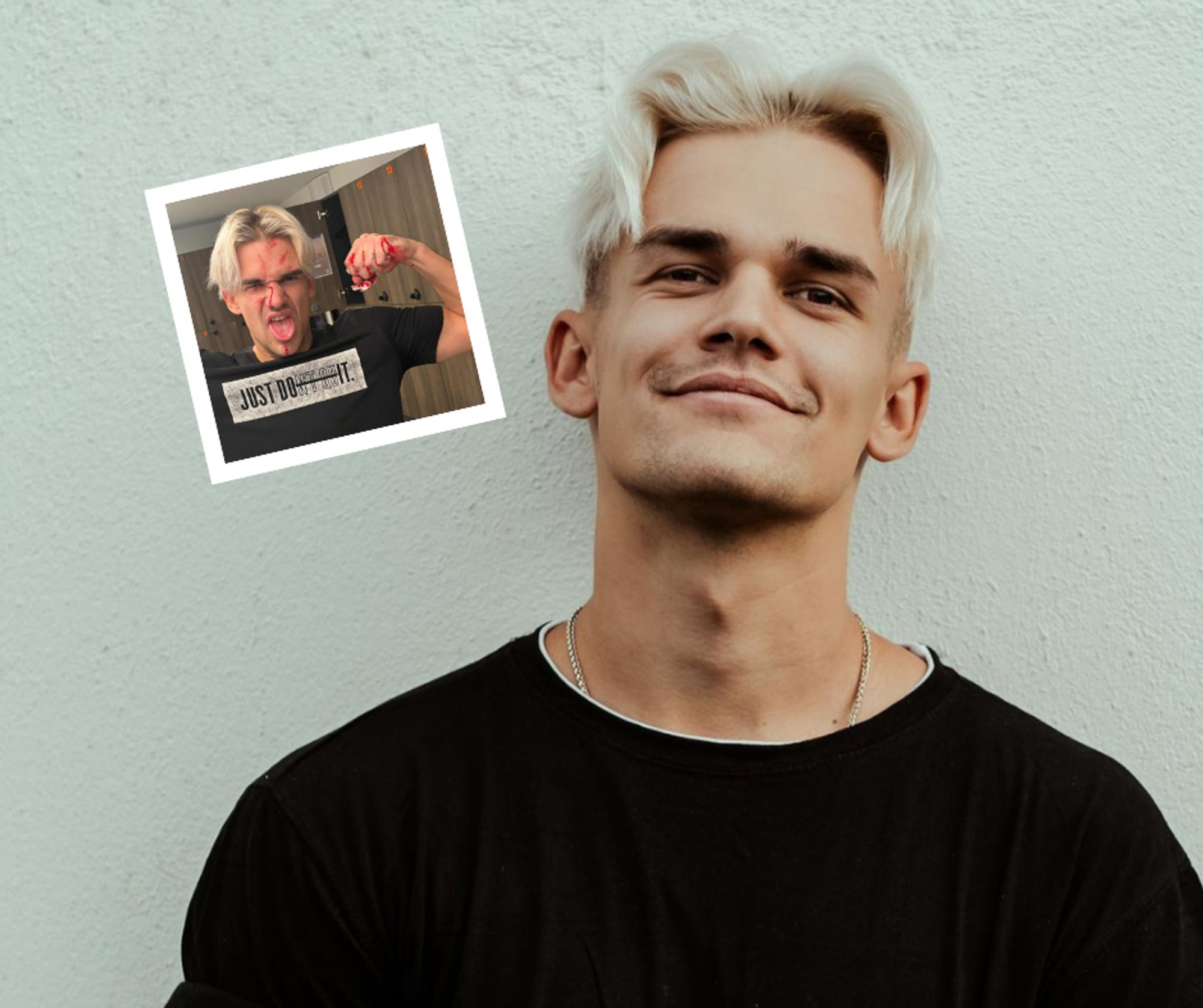 Muusik Rozell murdis padelit mängides ninaluu. „Lõin ise endale reketiga näkku“