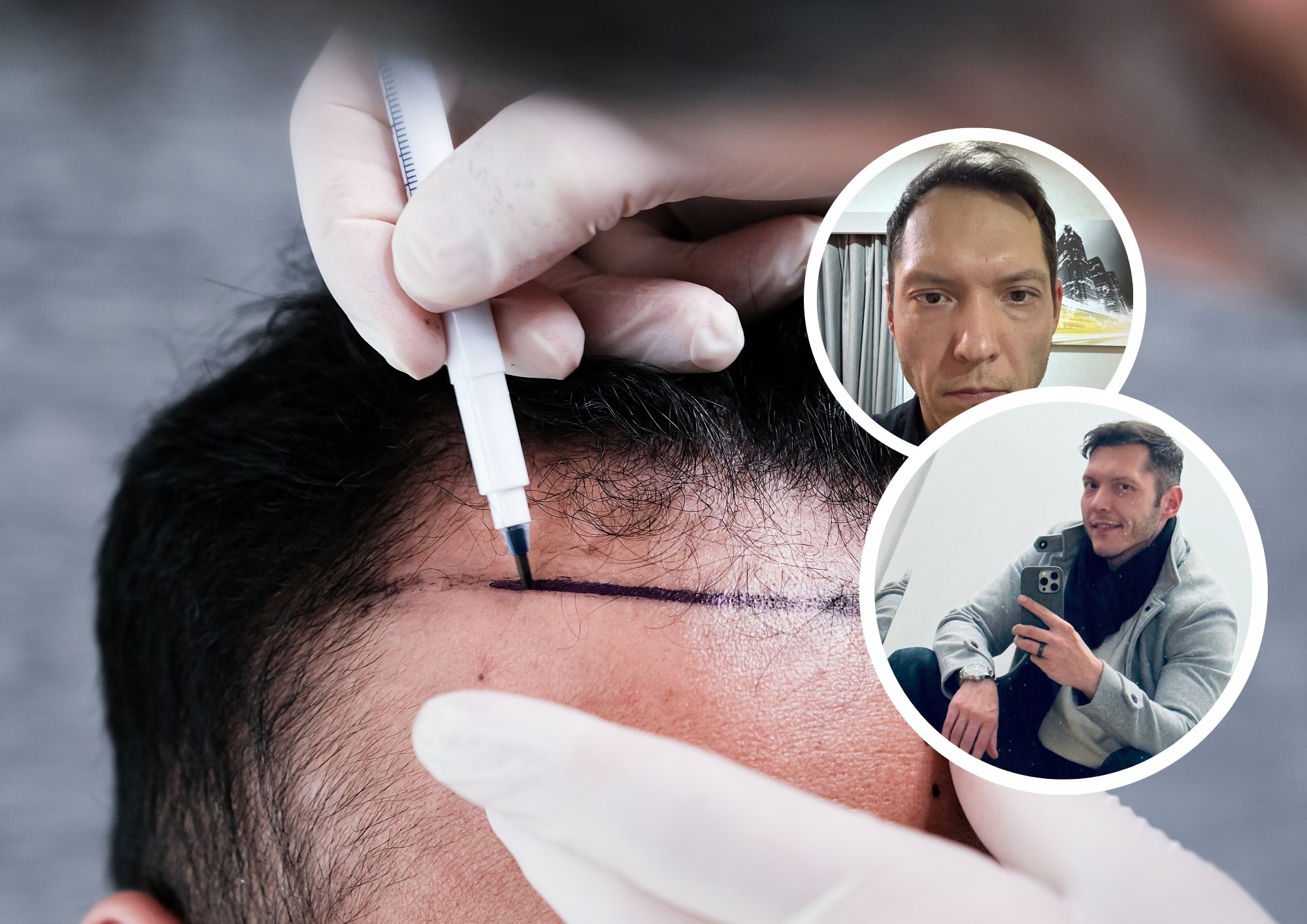 „Valehäbi ei tasu tunda. See on investeering iseendasse.“ Silver käis Istanbulis juukseid siirdamas ja jagab oma kogemust