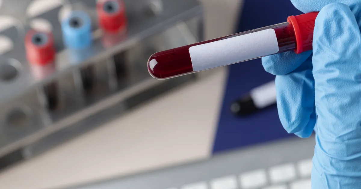 OOTAMATU OHT ⟩ Liiga madal «halva» kolesterooli tase võib viia diabeedini