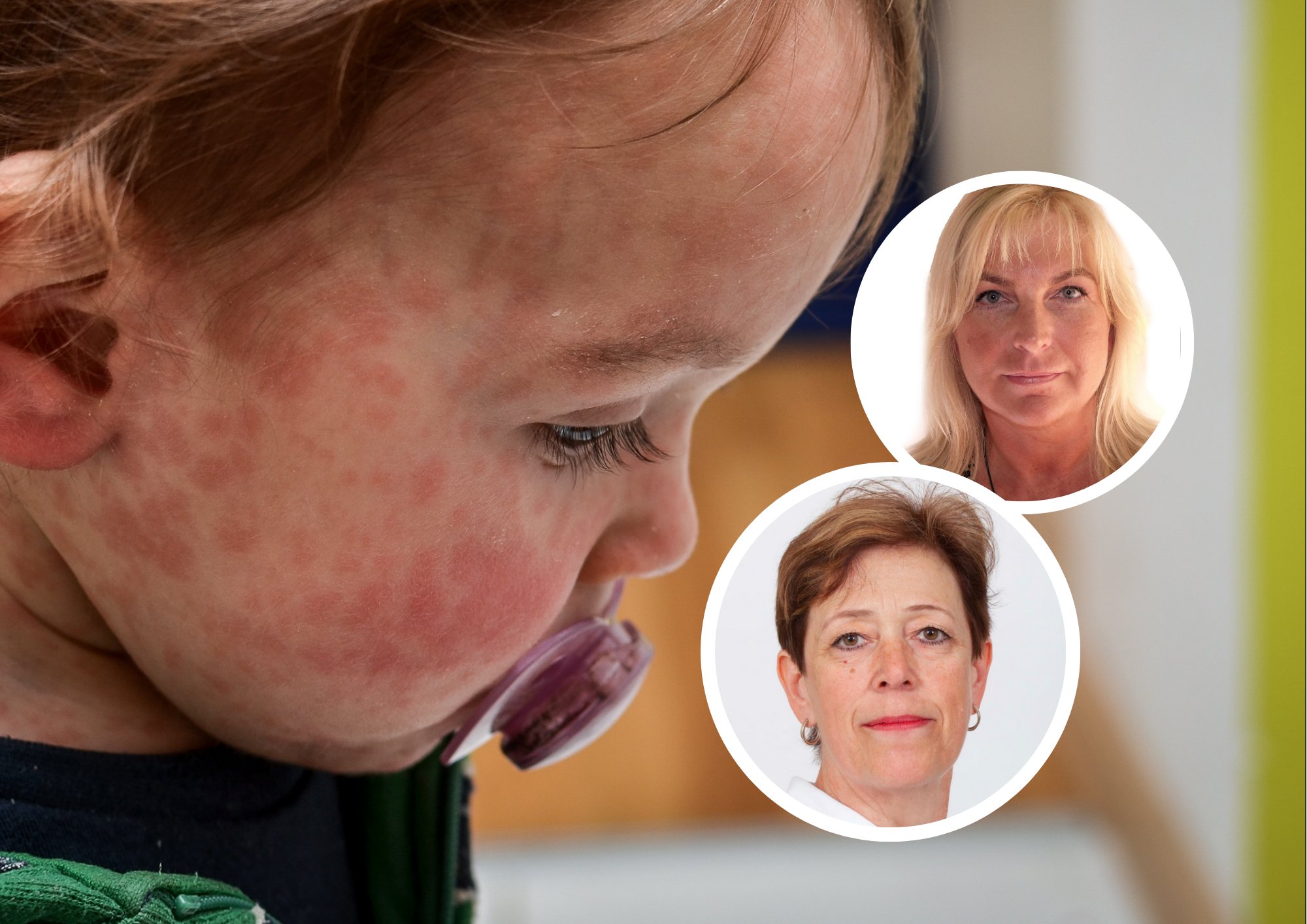 Eksperdid: leetrite levik Eestis näitab, et vaktsineerimine on langenud alla kriitilise piiri