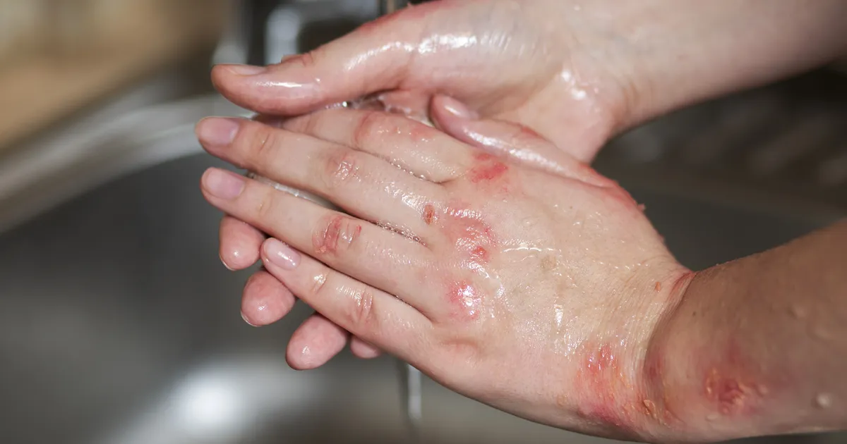 Leetrite levik USA-s purustas 30 aasta rekordi: olukord on kriitiline