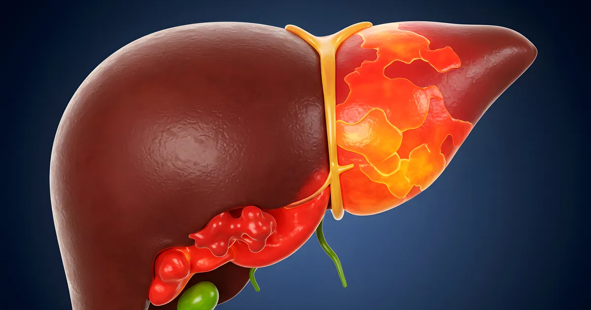 6 märki, mis võivad viidata rasvmaksa haigusele