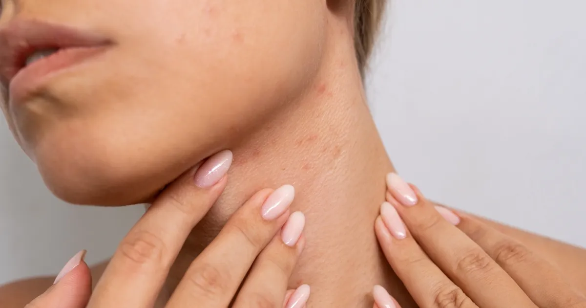 Nahaarstid hoiatavad: see talvine riideese põhjustab salaja vistrikke