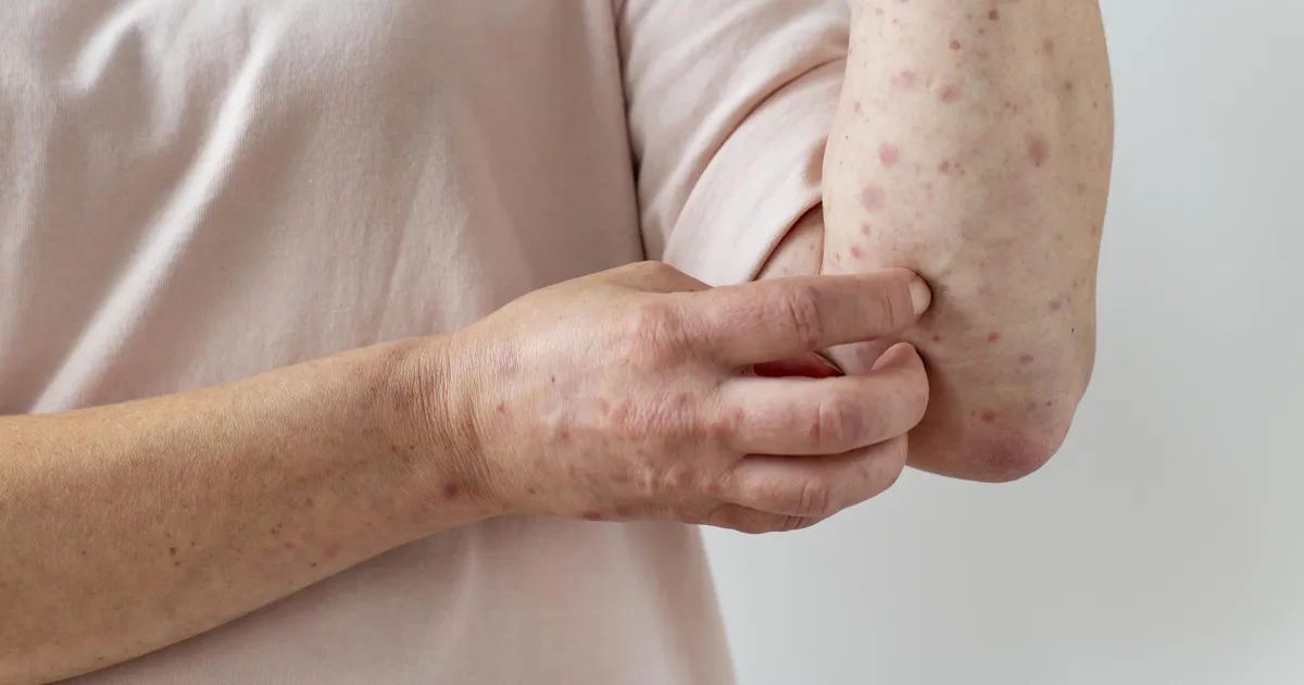 Euroopa kaotab kontrolli: ohtlik ja unustatud nakkushaigus on ametlikult tagasi