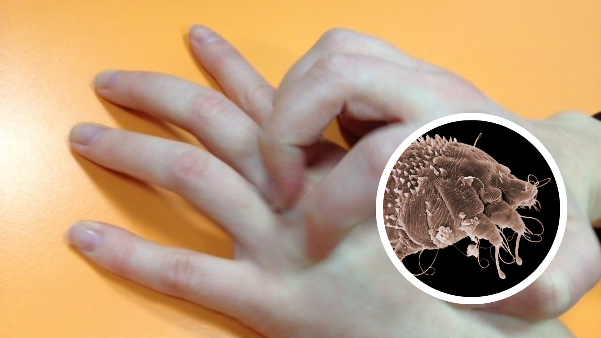 Terviseamet rahustab: sügeliste levik ei ole Eestis kasvutrendis