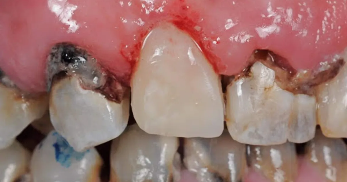 INIMKATSETE TULEMUS ⟩ Selle aminohappega saab võidelda hambaaukude ja kaariesega