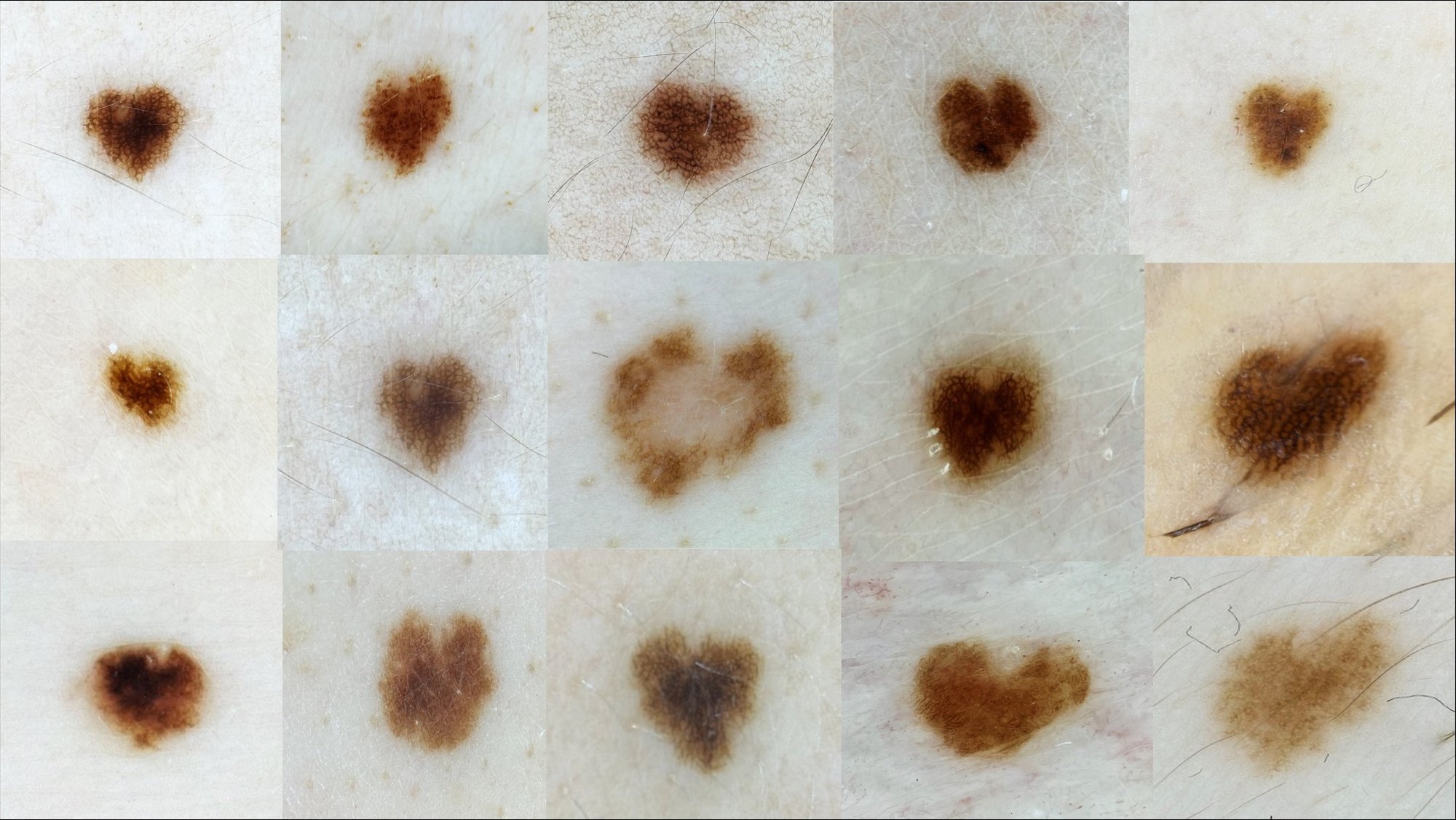 Miks tekivad erilised, näiteks südamekujulised, sünnimärgid? Healoomuliste ja pahaloomuliste sünnimärkide tunnused