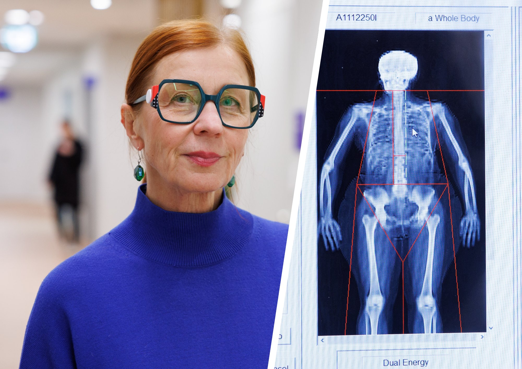 „Luutiheduse uuringuid tehakse Eestis liiga vähe ja sellepärast ei saa paljud ravi.“ Kuidas ennetada haigust, mis murrab luid?