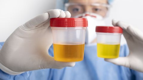 Ehmatav sümptom uriinis, mida ei tohiks tähelepanuta jätta