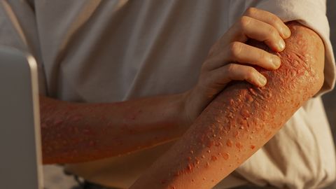 ETTEVAATUST ⟩ Temu toode tekitas Soome naisele karmi nahareaktsiooni