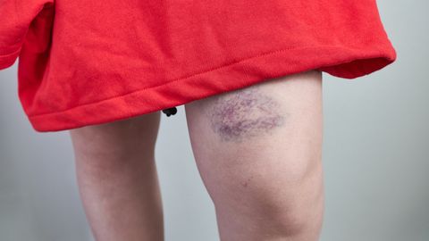 Kui sinikas pole lihtsalt sinikas: nähtamatu haigus, mis vajab kiiret märkamist